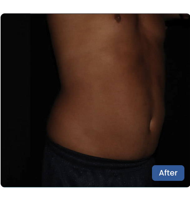 CoolSculpting Elite after — Abdomen