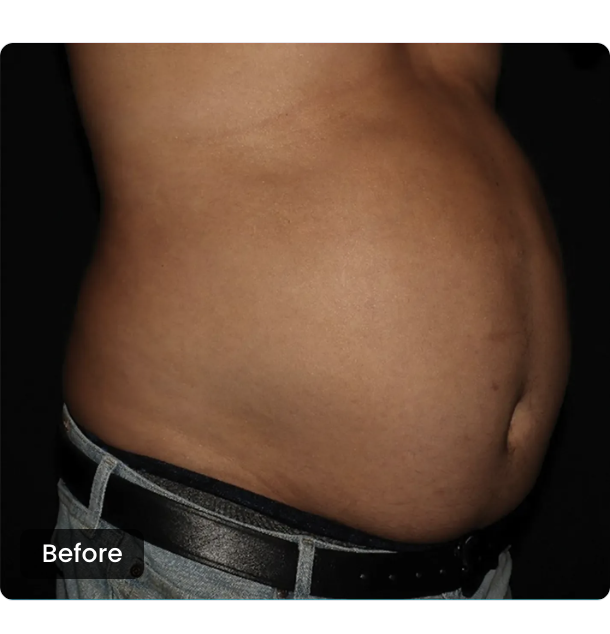 CoolSculpting Elite before — Abdomen