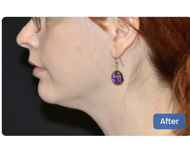 CoolSculpting Elite after — Chin & Neck