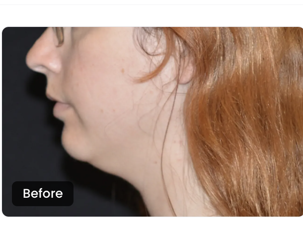 CoolSculpting Elite before — Chin & Neck
