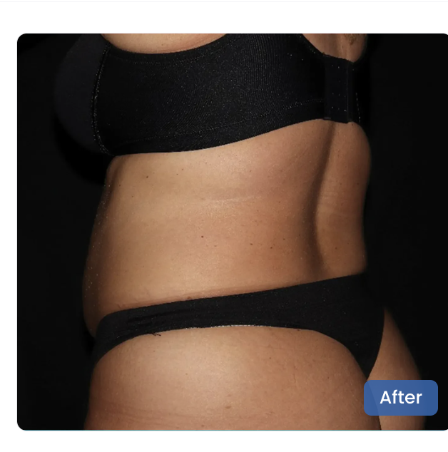 CoolSculpting Elite after — Waist & Flanks