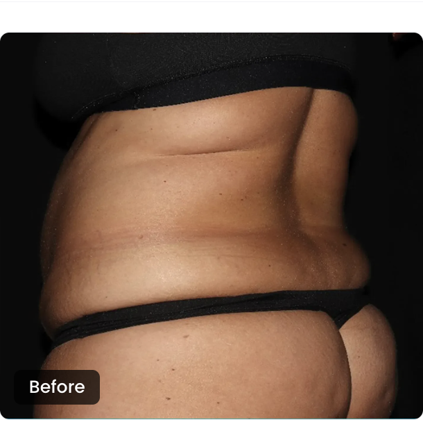 CoolSculpting Elite before — Waist & Flanks